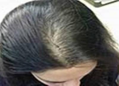 ارتباط بین پوست خشک و ریزش مو