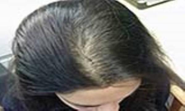 ارتباط بین پوست خشک و ریزش مو